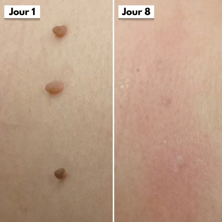 DermaSkin Pro™ - Dites Adieu aux Acrochordons