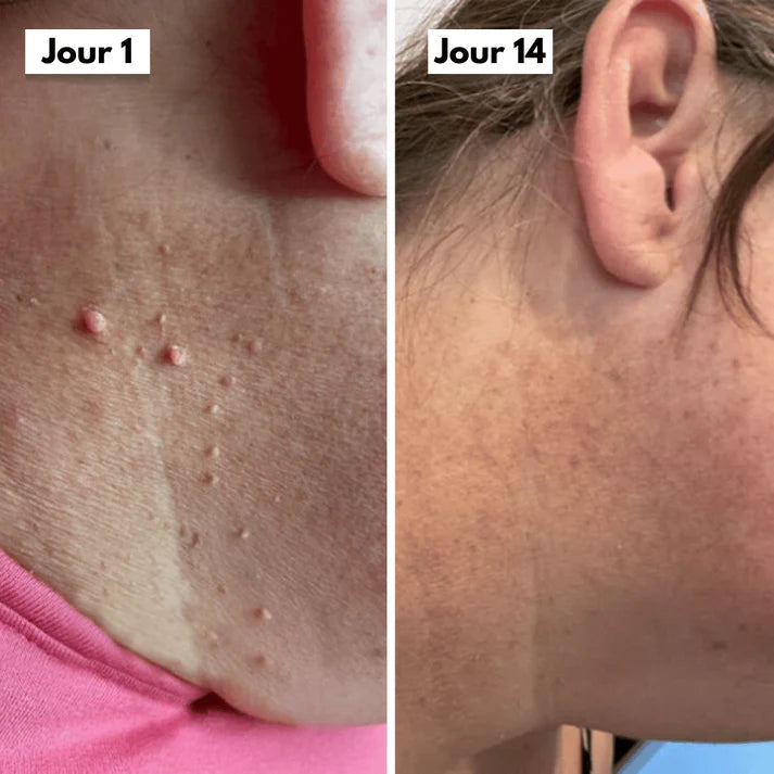DermaSkin Pro™ - Dites Adieu aux Acrochordons