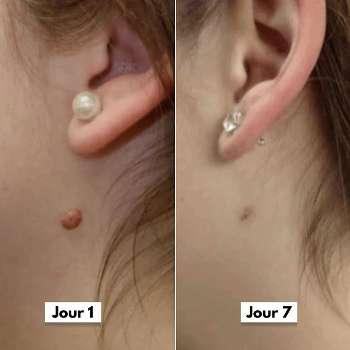 DermaSkin Pro™ - Dites Adieu aux Acrochordons