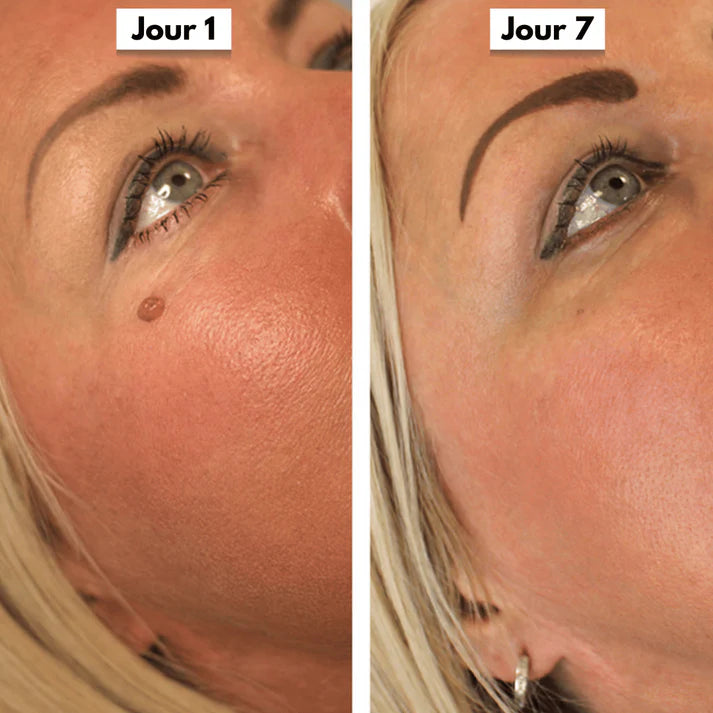 DermaSkin Pro™ - Dites Adieu aux Acrochordons