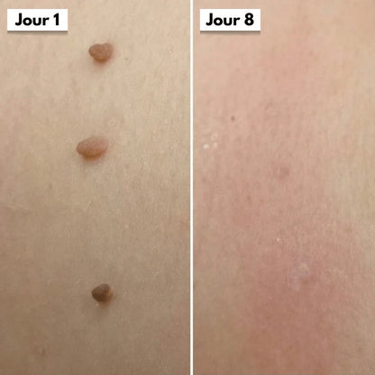 DermaSkin Pro™ - Dites Adieu aux Acrochordons