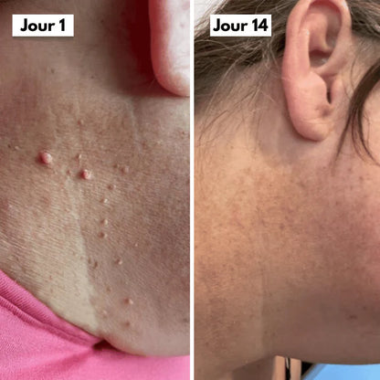 DermaSkin Pro™ - Dites Adieu aux Acrochordons