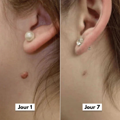 DermaSkin Pro™ - Dites Adieu aux Acrochordons